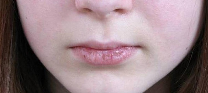 ¿Cómo curar los labios partidos rápido?